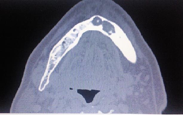 Osteonecrosis mandibular